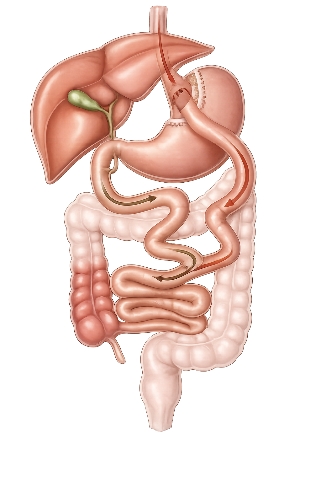 Ilustração anatômica do bypass gástrico